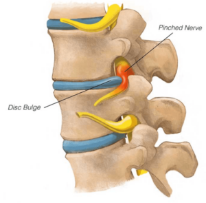 Spine of the low back with a disc bulge compressing a nerve