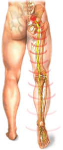 Symptoms traveling from the low back down one leg due to a disc bulge