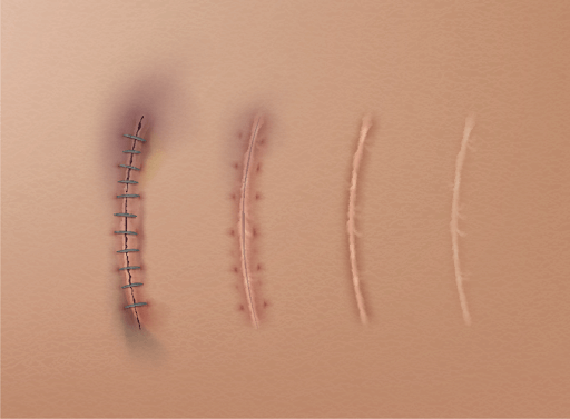 Stages of Scar (Tissue) Healing