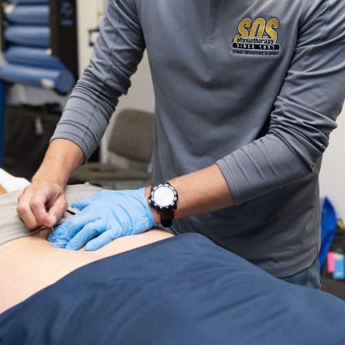 Dry-needling-SOS-Physiotherapy-Elmira-Waterloo-Kitchener-ON