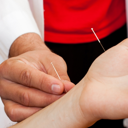 acupuncture-SOS-Physiotherapy-Elmira-Waterloo-Kitchener-ON