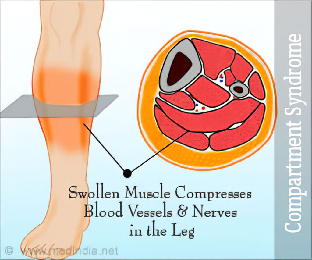 Diagram of cross section of the lower leg in someone with compartment syndrome. Redness on the leg shows swelling and discomfort.