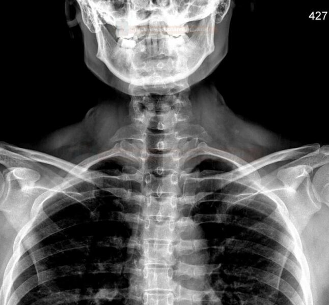 X-ray of upper chest and neck
