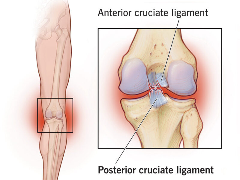 Ligament tear in the right knee joint