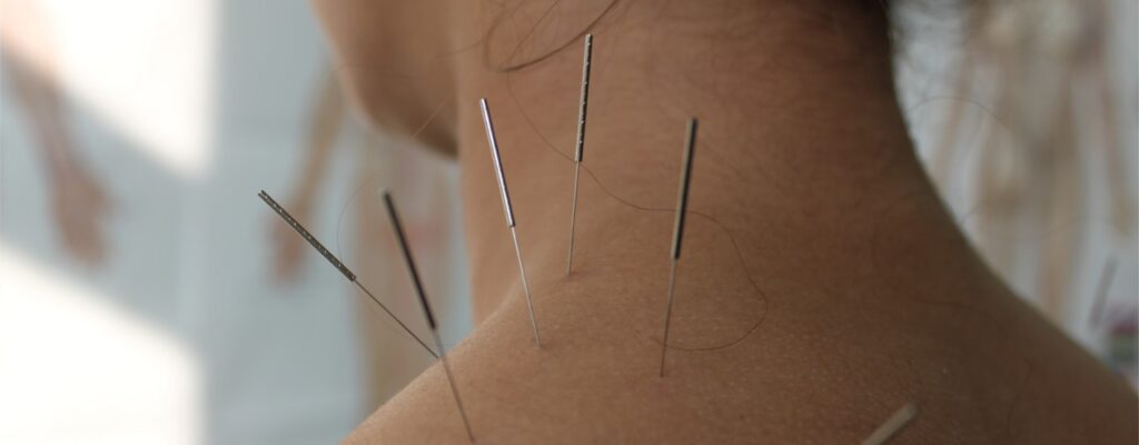 Dry Needling vs. Acupuncture: Understanding the Differences