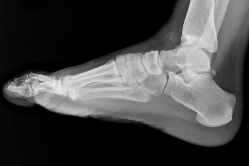 Ankle sprains