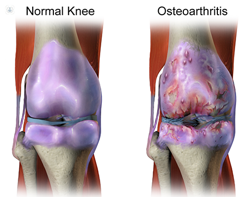 Two knees, the knee on the left shows a new & healthy knee while the knee on the right shows a knee with Osteoarthritis & the war & tear it has put on the joing