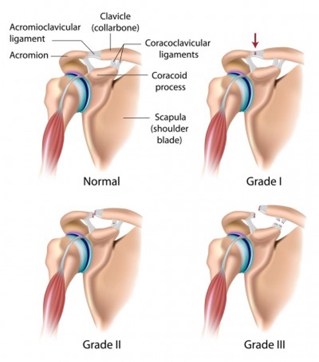 What are the grades of an AC Joint sprain. Common hockey shoulder injury.
