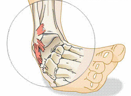 Cartoon picture showing anatomy of the outer ankle and possibly injured ligaments from rock climbing