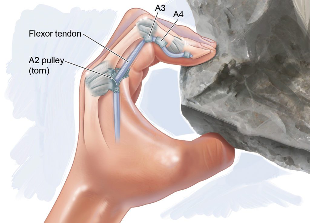 Hand gripping rock while rock climbing shows A2 Pulley and flexor tendon in pointer finger