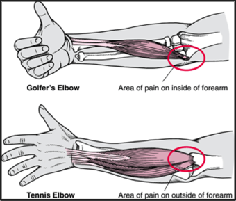 To arm showing the flexor and extensor muscles associated with golfers elbow and tennis elbow, common rock climbing injuries