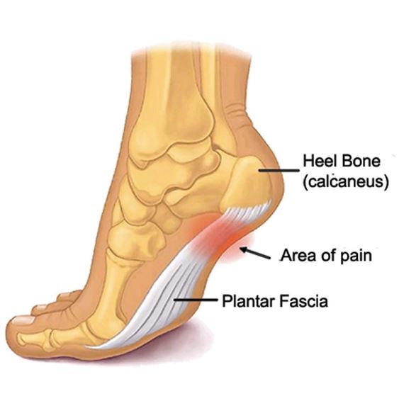 plantar fascia area of pain