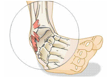 Ankle sprain injurie from being rolled