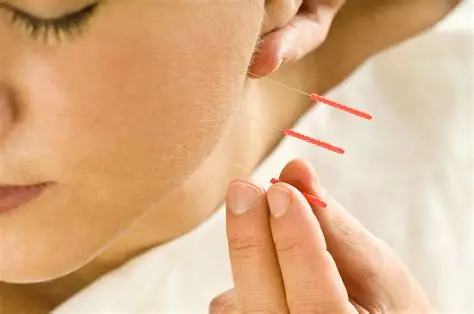 TMJ acupuncture dry needling treatment physiotheapy