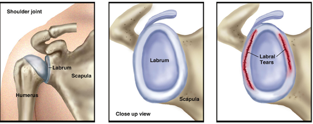 Shoulder labrum tear close-up view